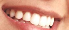 implantes-dentarios-porto-seguro-1382371974